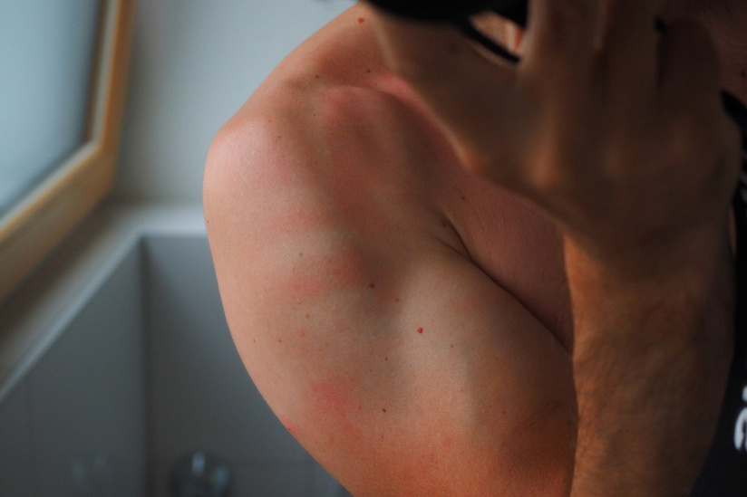 Engelures, rougeurs, urticaire... des symptômes cutanés du Covid-19 selon les dermatologues