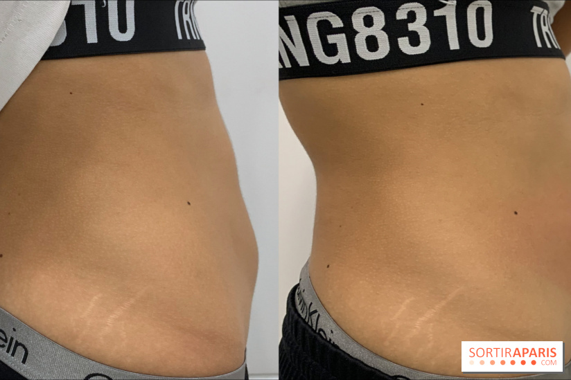 Soin Cryolipolyse chez Cryobar