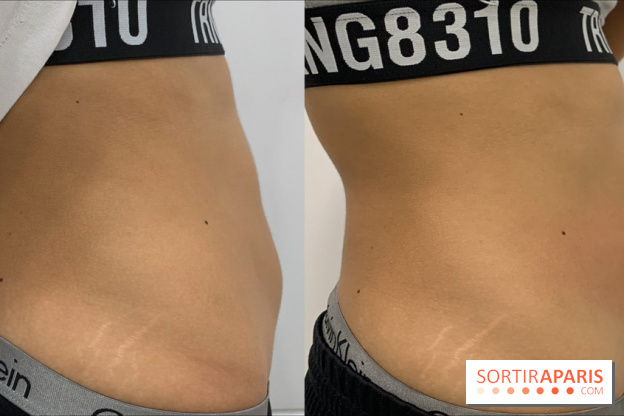 Soin Cryolipolyse chez Cryobar