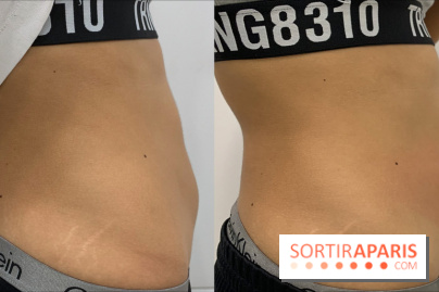 Soin Cryolipolyse chez Cryobar