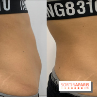 Soin Cryolipolyse chez Cryobar