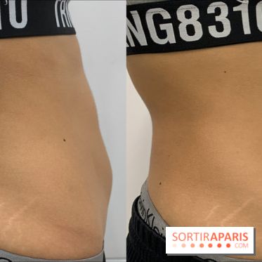 Soin Cryolipolyse chez Cryobar