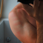 Engelures, rougeurs, urticaire... des symptômes cutanés du Covid-19 selon les dermatologues