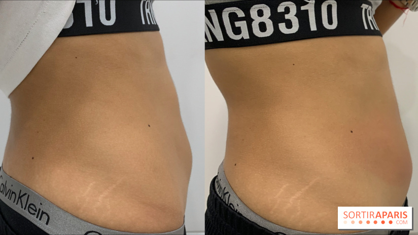 Soin Cryolipolyse chez Cryobar