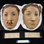 Paris Insolite : le Musée des Moulages de l'hôpital Saint-Louis