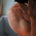 Engelures, rougeurs, urticaire... des symptômes cutanés du Covid-19 selon les dermatologues